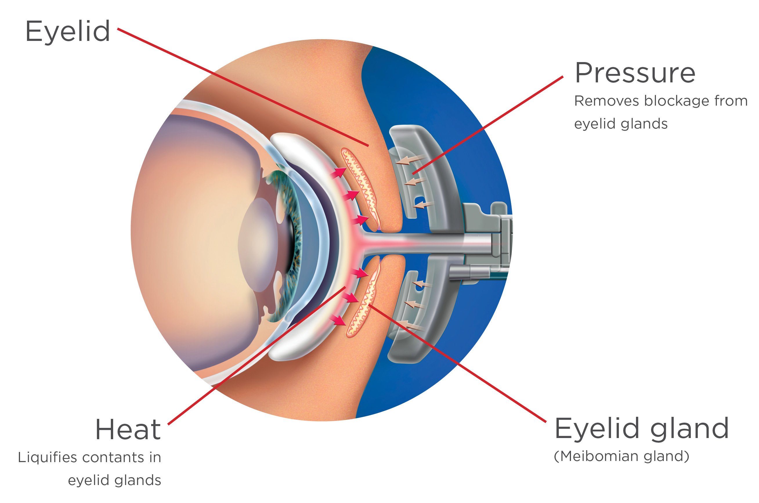 LipiFlow cross section labels